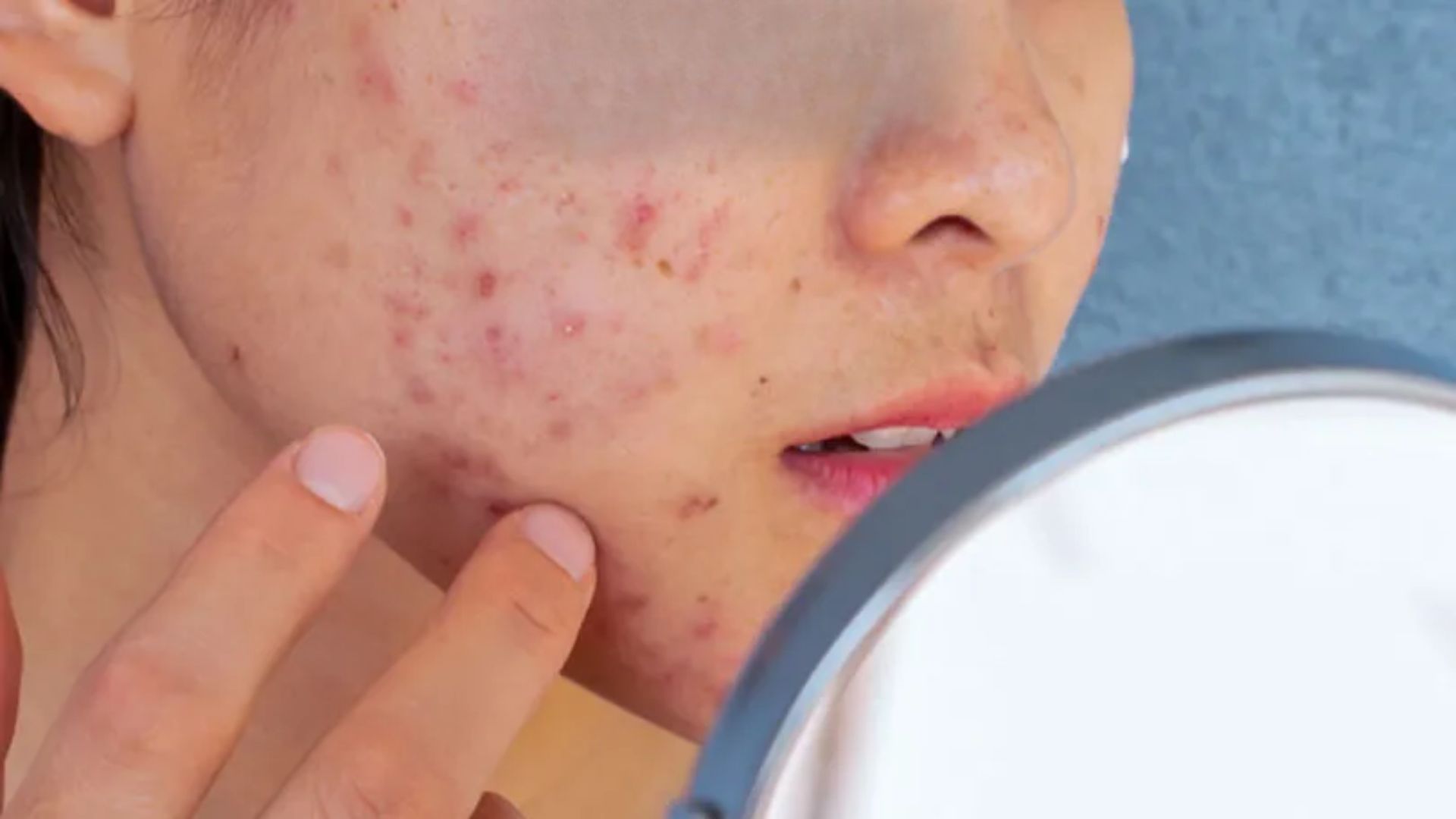 acne-prone skin